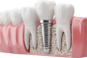 replace teeth with implants