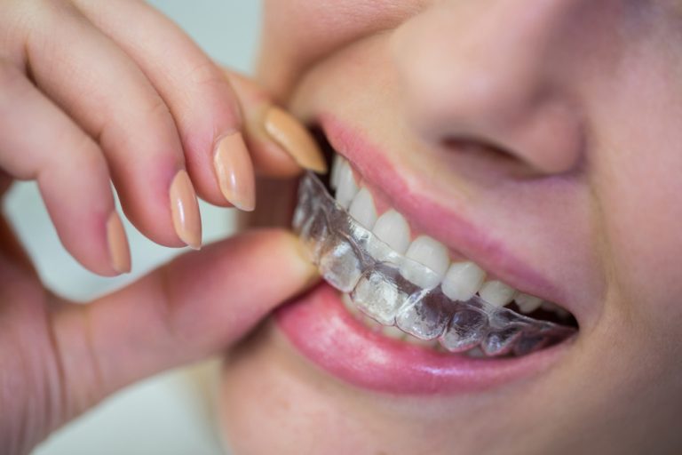 best clear aligners